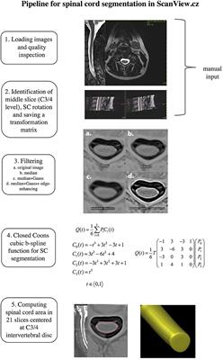 Additive Effect of Spinal Cord Volume, Diffuse and Focal Cord Pathology on Disability in Multiple Sclerosis